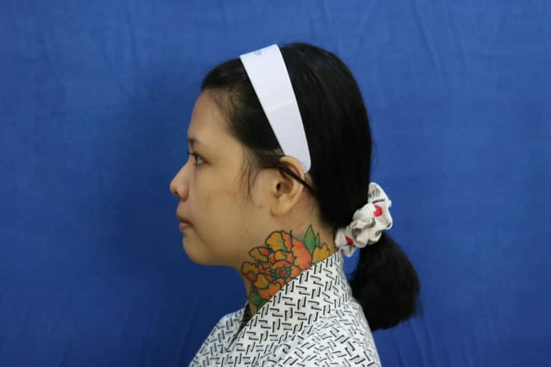 如何在「蜜絲歐妮診所」找到自信——我的隆鼻經驗