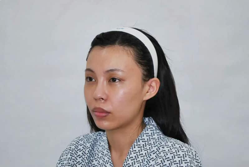 「蜜絲歐妮診所」全臉補脂體驗：讓你的五官更精緻！