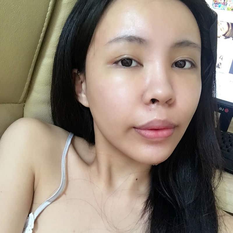 提升自信的選擇：「蜜絲歐妮診所」全臉補脂經驗談