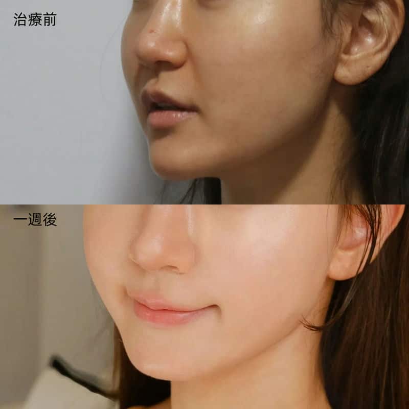 蜜絲歐妮診所的水光注射，讓肌膚煥發韓星般光彩