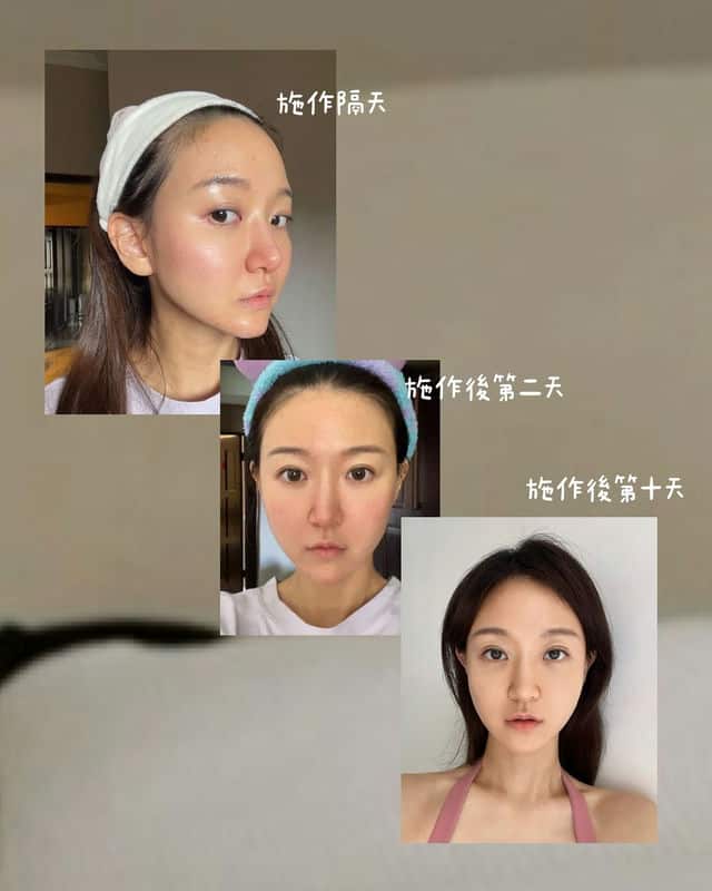 蜜絲歐妮診所的水光注射：經驗分享與肌膚改善之路