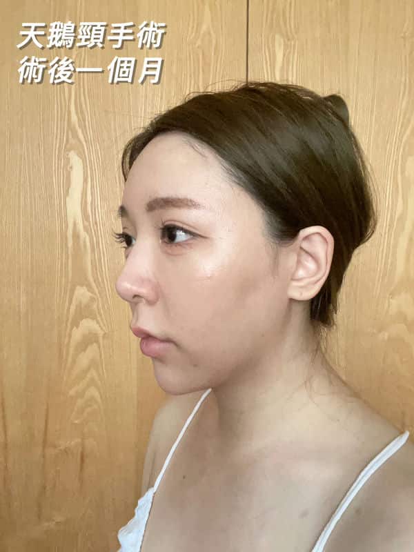 「蜜絲歐妮診所」的天鵝頸手術體驗